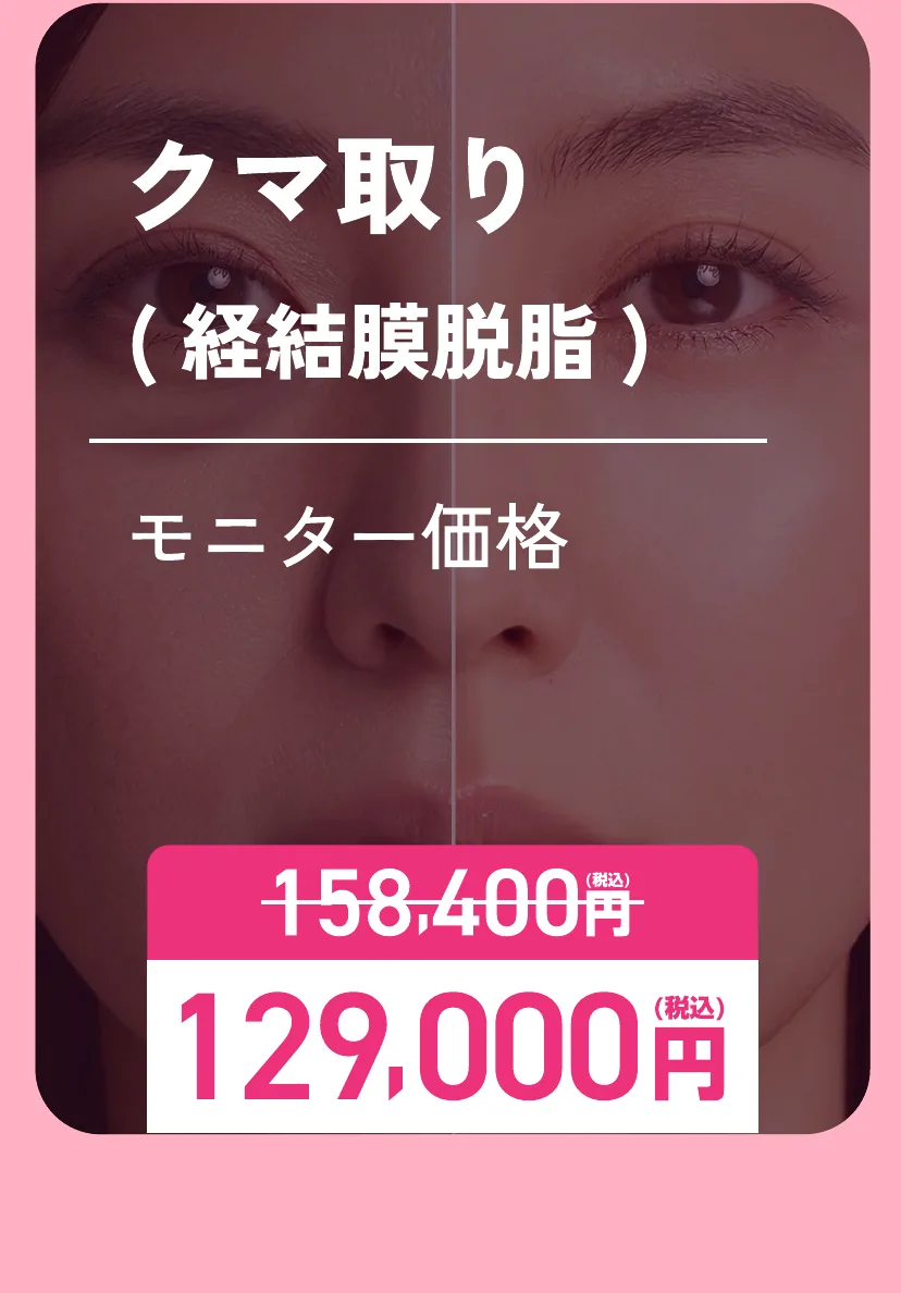 クマ取り(経結膜脱脂)モニター価格 通常158,400円が129,000円(税込)