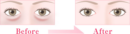 下瞼の脂肪除去