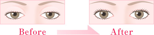 上瞼の脱脂(脂肪取り)