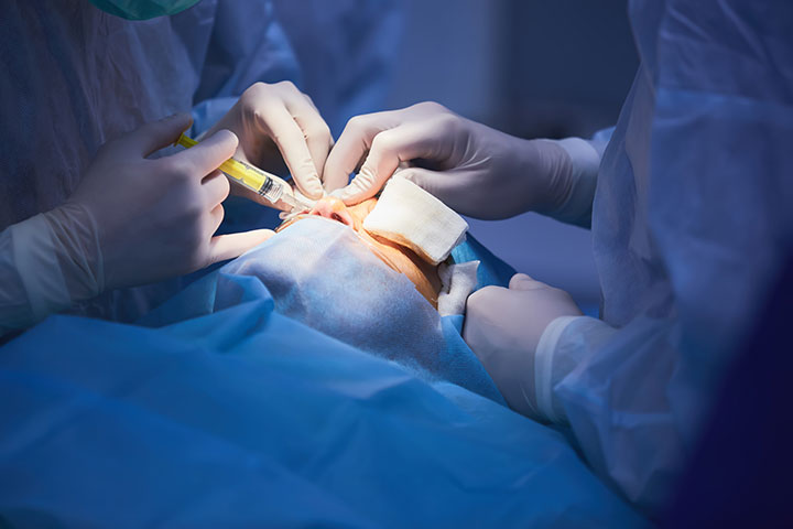 切開法による二重整形の方法について