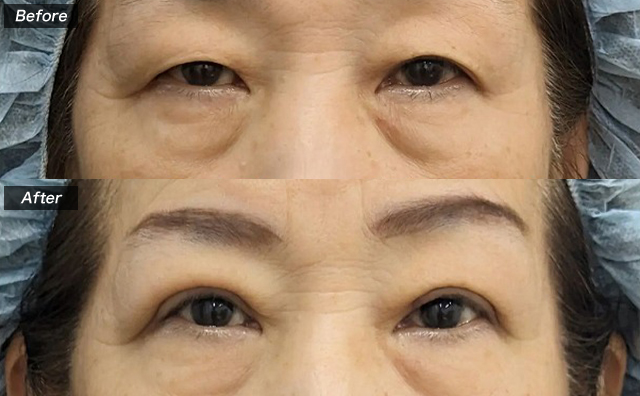 挙筋腱膜前転法