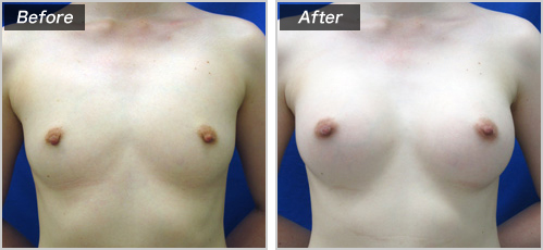 人工乳腺法(シリコンバッグ)による症例写真① 正面