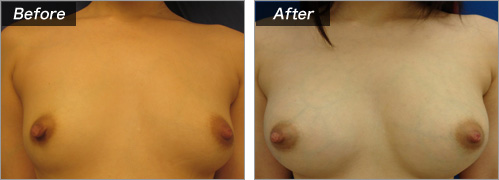 人工乳腺法(シリコンバッグ)による症例写真③ 正面
