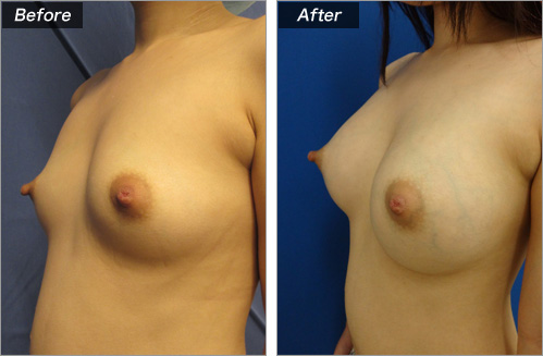 人工乳腺法(シリコンバッグ)による症例写真② 横