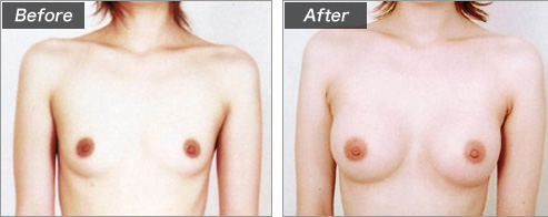 人工乳腺法(シリコンバッグ)による症例写真④ 正面