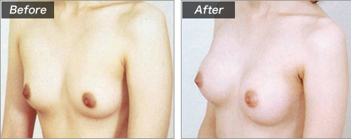 人工乳腺法(シリコンバッグ)による症例写真④ 横
