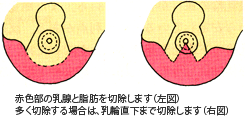 乳房固定術