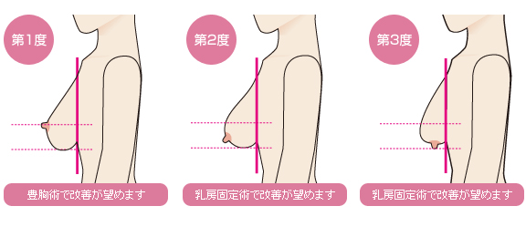 乳房固定術 イラスト解説
