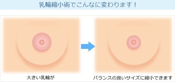 乳輪縮小術 before afterイラスト