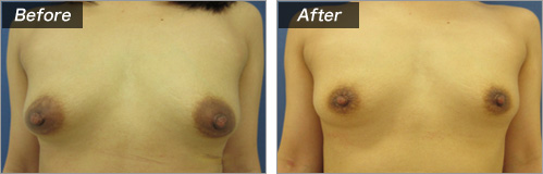 乳輪縮小術 症例写真①正面