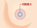 乳頭の近接部分(内側)を切除する方法