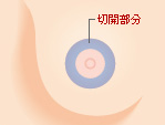 乳輪の一番外側を切除する方法