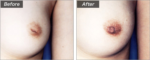 陥没乳頭形成術 before after