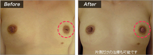 陥没の程度について 症例写真①