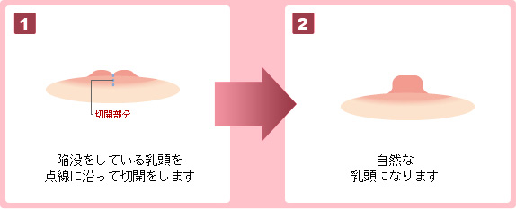 傷跡はほとんど目立ちません
