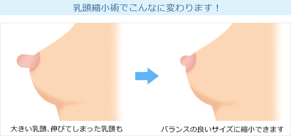 乳頭縮小術 イラスト解説