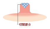 授乳機能を温存しない場合
