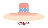 授乳機能を温存する場合