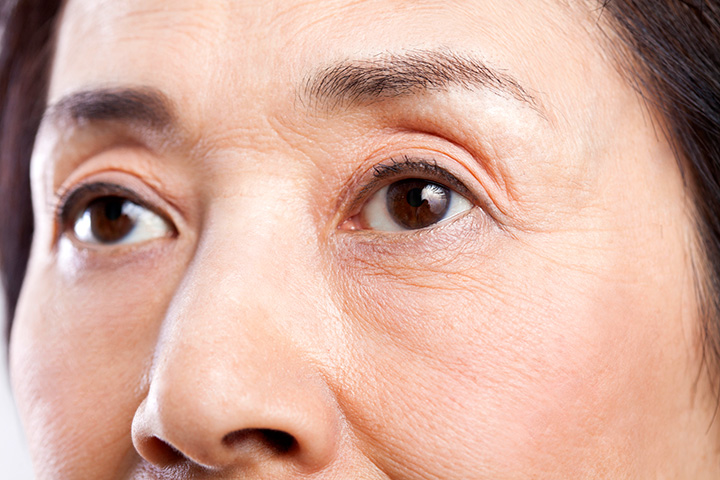 上瞼の脂肪が多いというのはどのような状態？