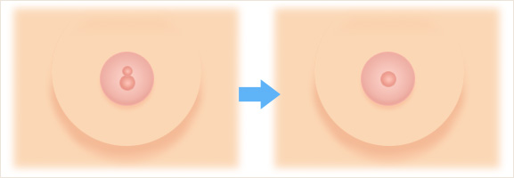 分裂乳頭の手術方法 イラスト