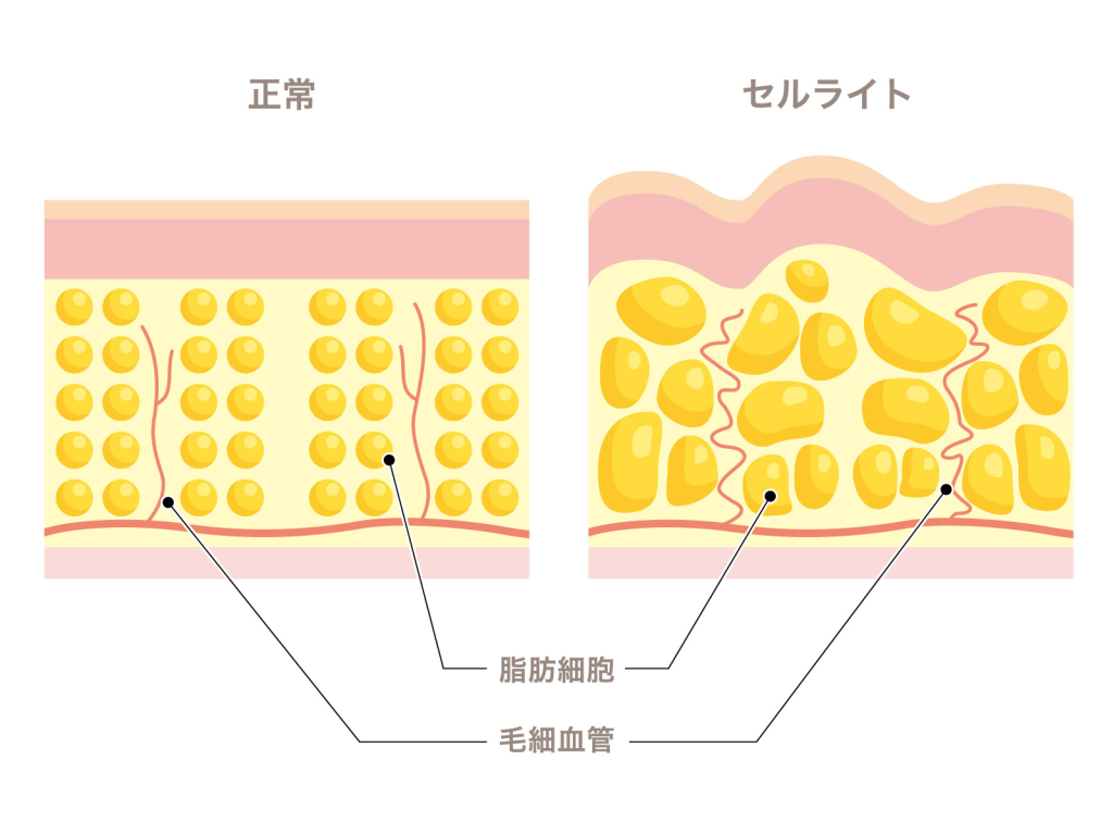 セルライトとは