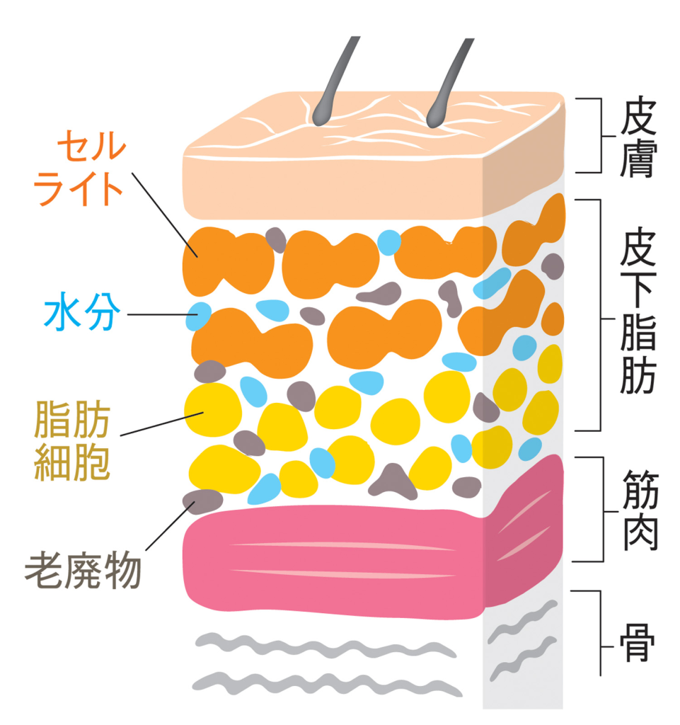 脂肪やセルライトの蓄積