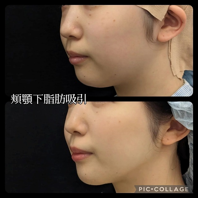 脂肪吸引
