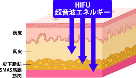 HIFU超音波エネルギー