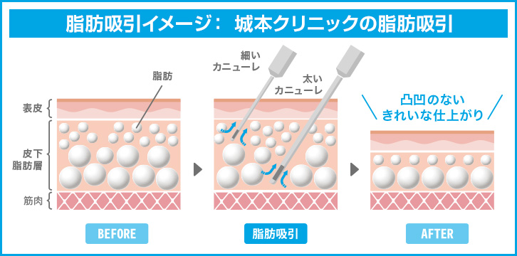 脂肪吸引イメージ