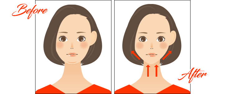 コラーゲン生成による引き締め効果 (術前・術後)イラスト