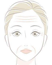真皮性しわ