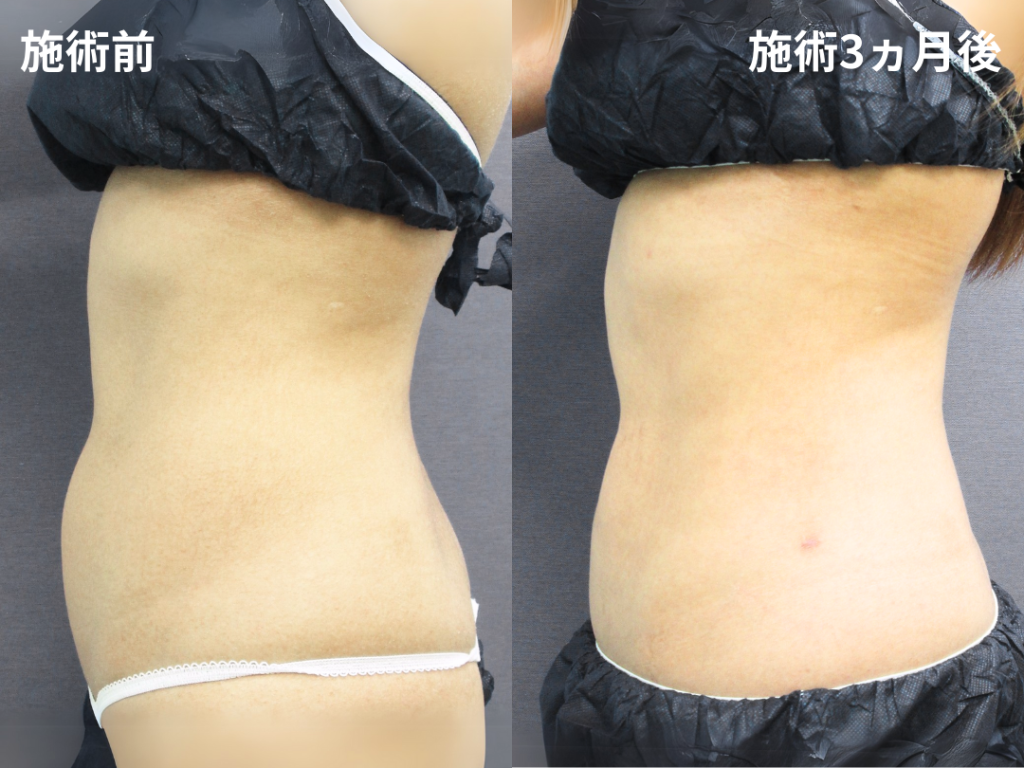 脂肪吸引症例写真 サイド(術前・術後)①
