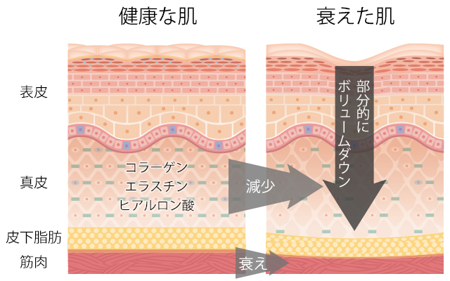 健康な肌と衰えた肌