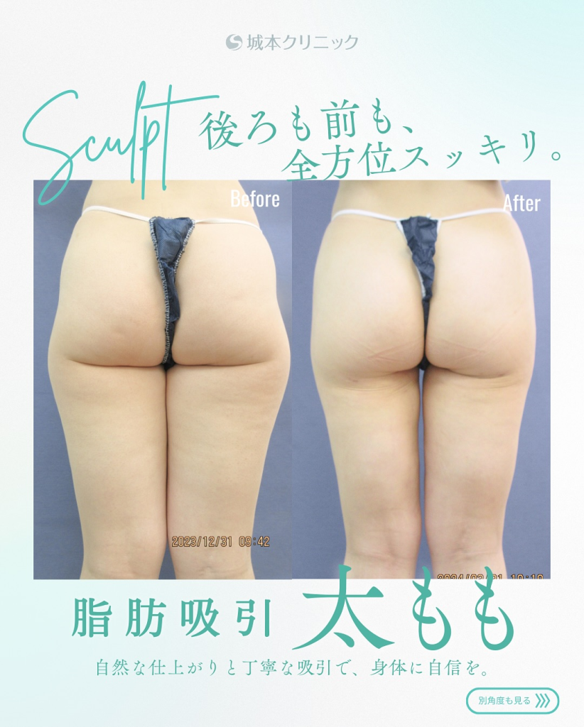 脂肪吸引 太もも 前方(術前・術後)
