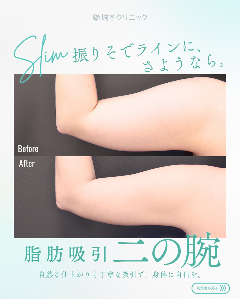 二の腕の脂肪吸引の症例写真