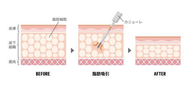 脂肪吸引イラスト解説