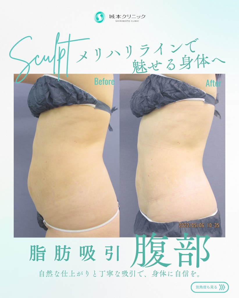 お腹の脂肪吸引の症例写真①