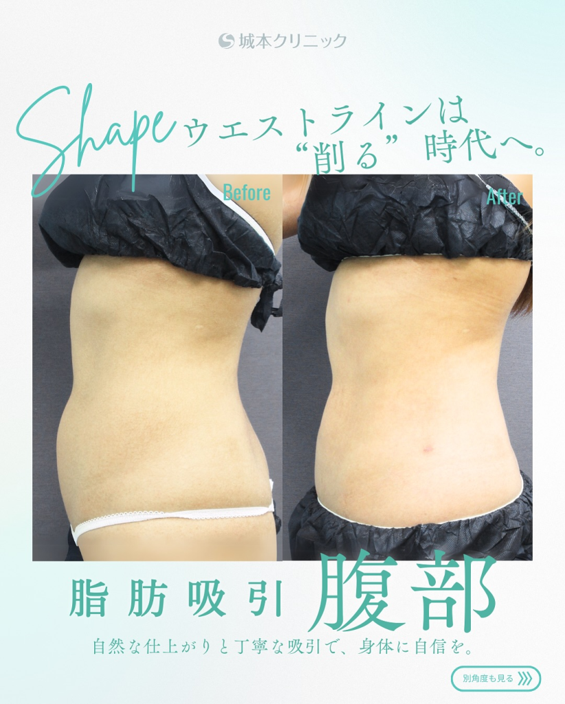 お腹の脂肪吸引の症例写真②