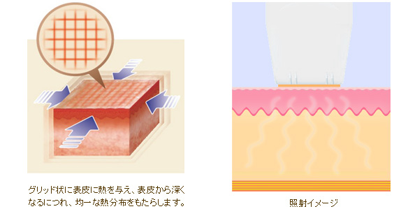 従来のラジオ波治療器とイントラジェンの違い