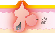 膿疱（のうほう）：膿ニキビ（イラスト解説）
