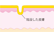 ニキビ跡：クレーター（イラスト解説）