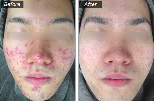 マクロピールの施術写真⑤