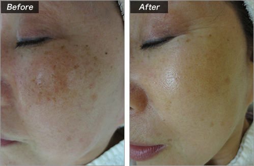シミの症例写真④（術前・術後）