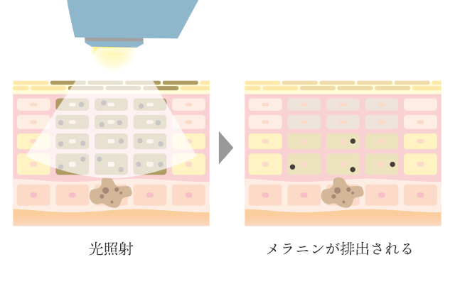 光治療（フォトフェイシャル　など）のイラスト解説