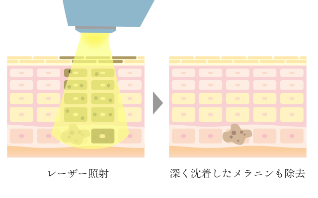 レーザー治療のイラスト解説