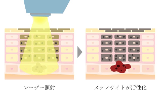 レーザートーニングのイラスト解説