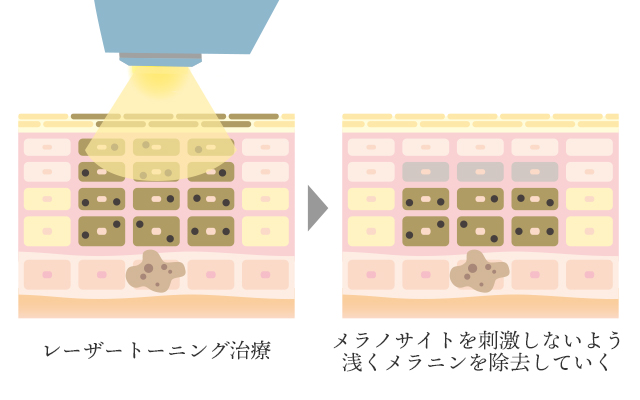 浅い層のメラニンを除去するレーザートーニングのイラスト解説