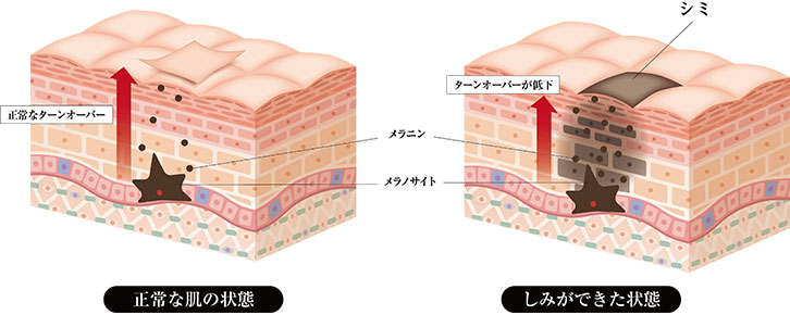 シミ・そばかす 発症のメカニズム(
イラスト解説）