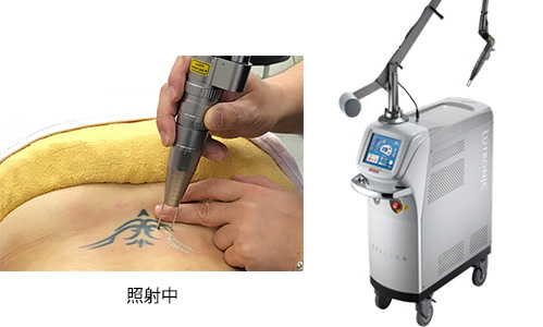 レーザー治療（スペクトラ）照射中