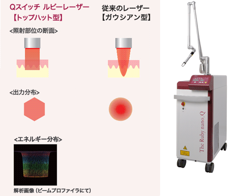 Qスイッチ ルビーレーザーのイラスト解説